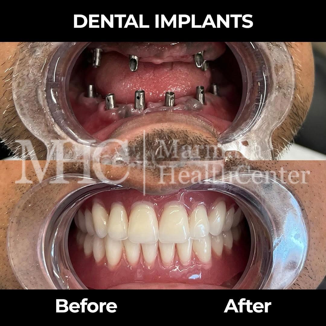 Dental implants before-after result