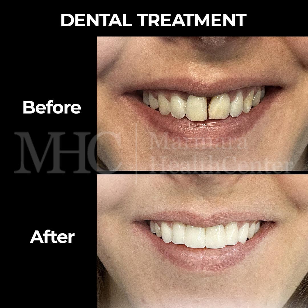 Dental treatment before-after — full mouth restoration
