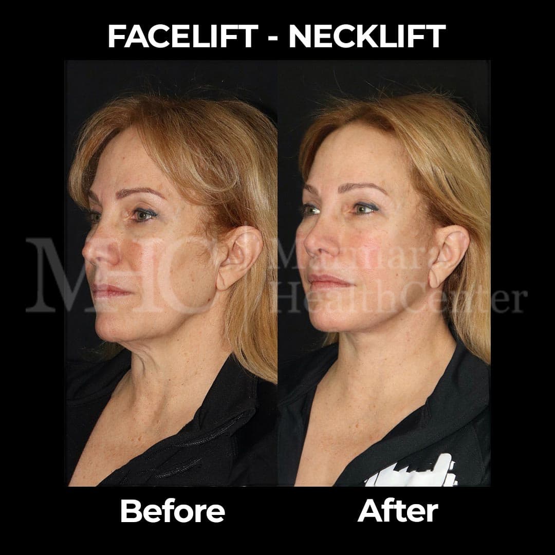 Facelift and necklift before-after result