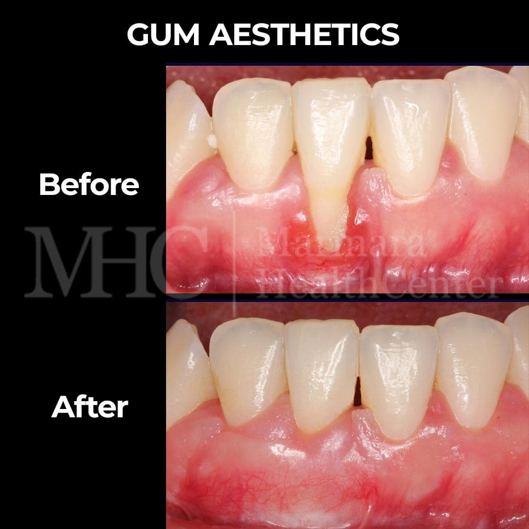 Gum aesthetics before-after result — gum contouring