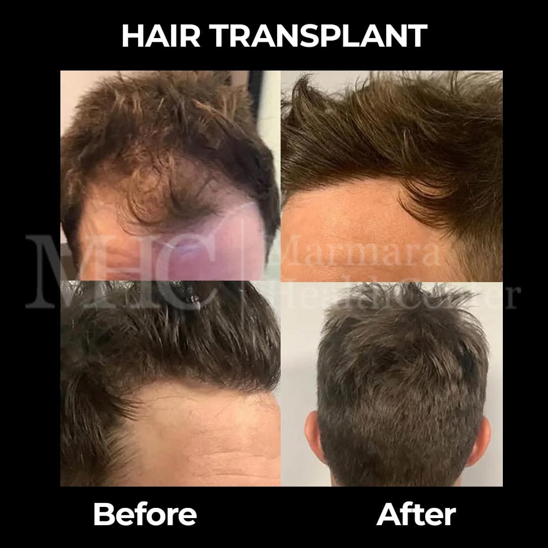 Hair transplantation before-after result — DHI method