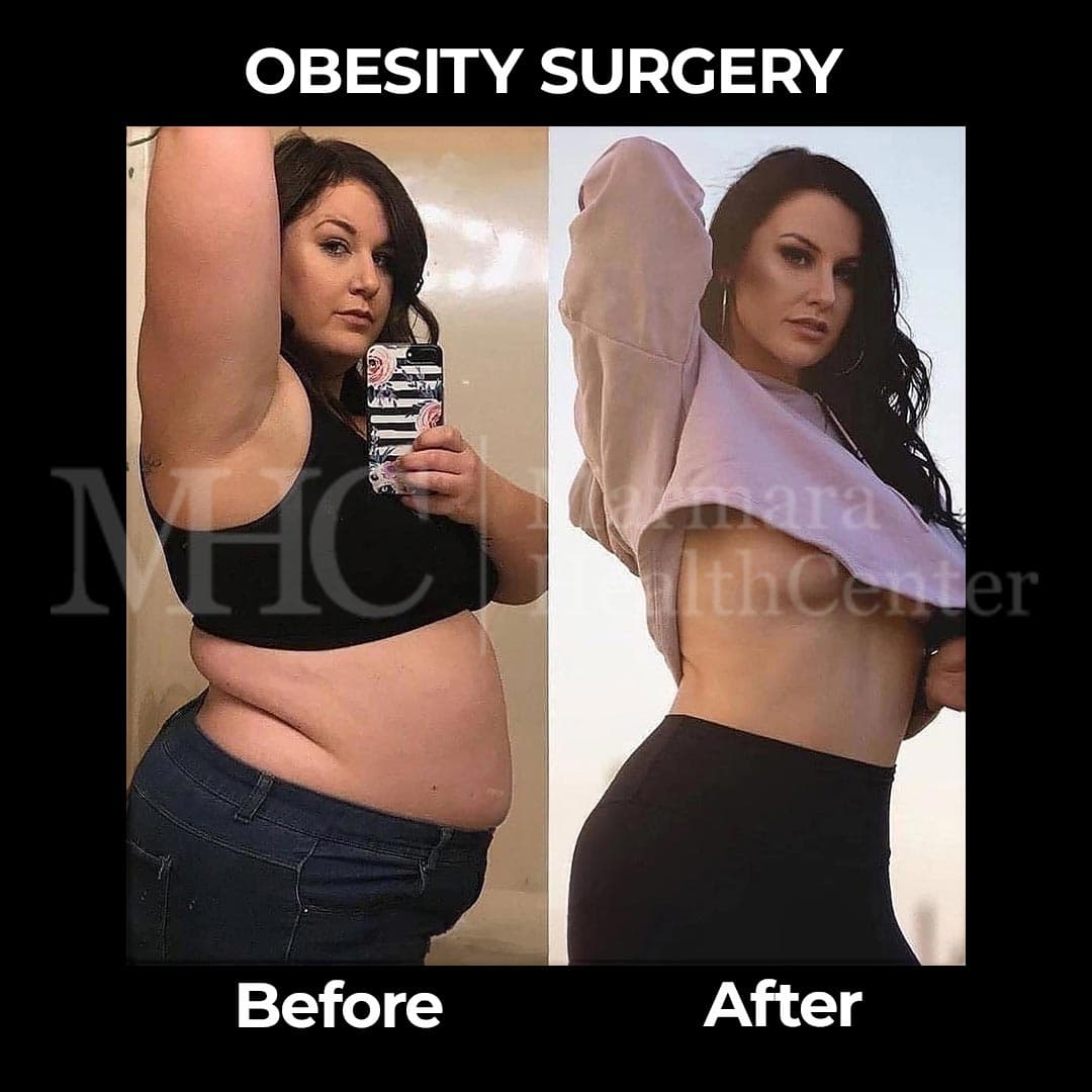 Obesity surgery before-after result at Marmara Health Center