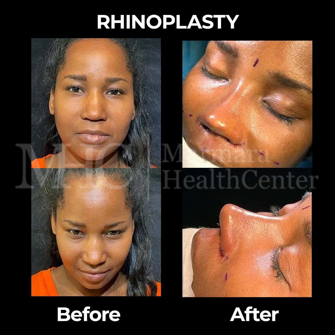 Rhinoplasty before-after result — nose aesthetic surgery