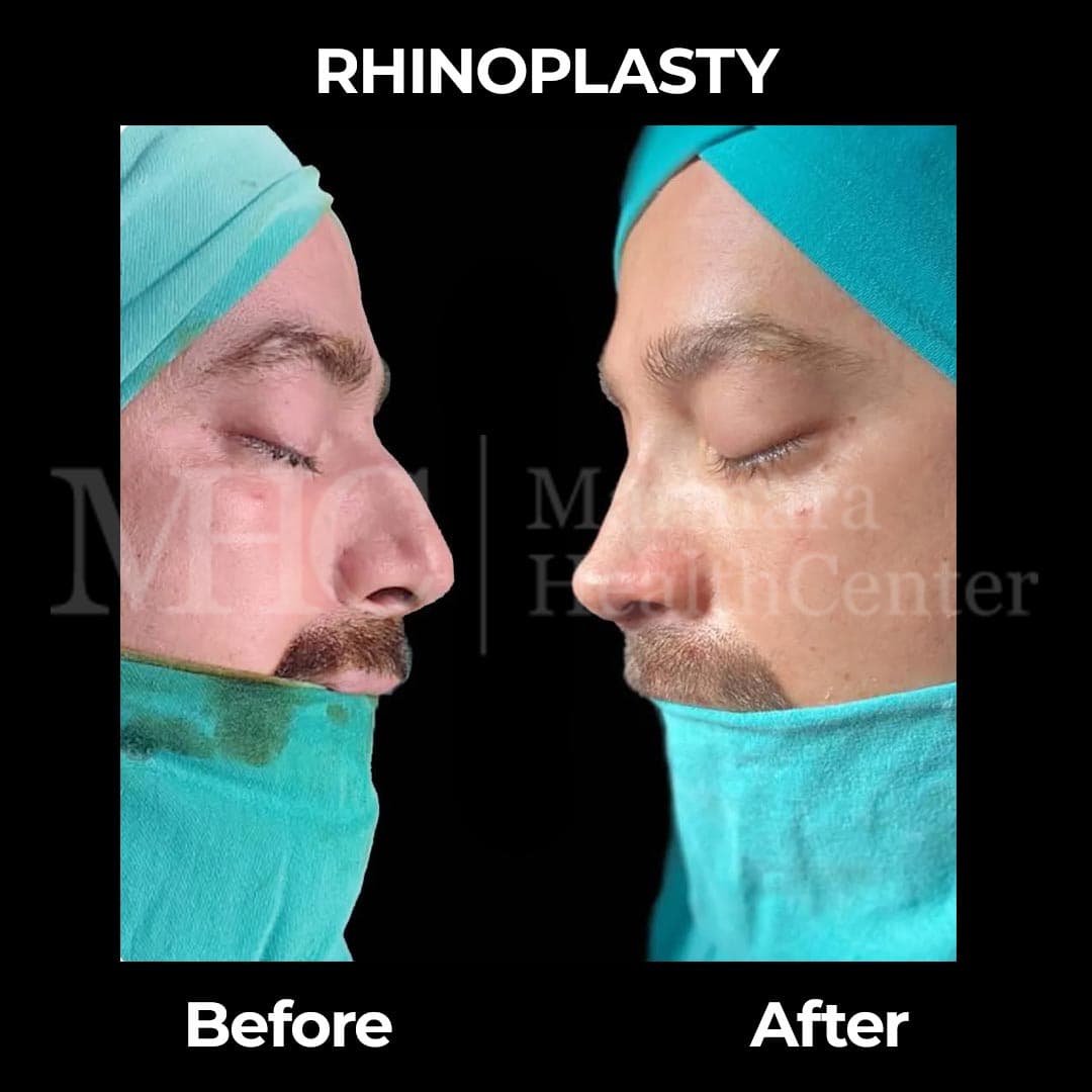 Rhinoplasty before-after result — nasal reshaping