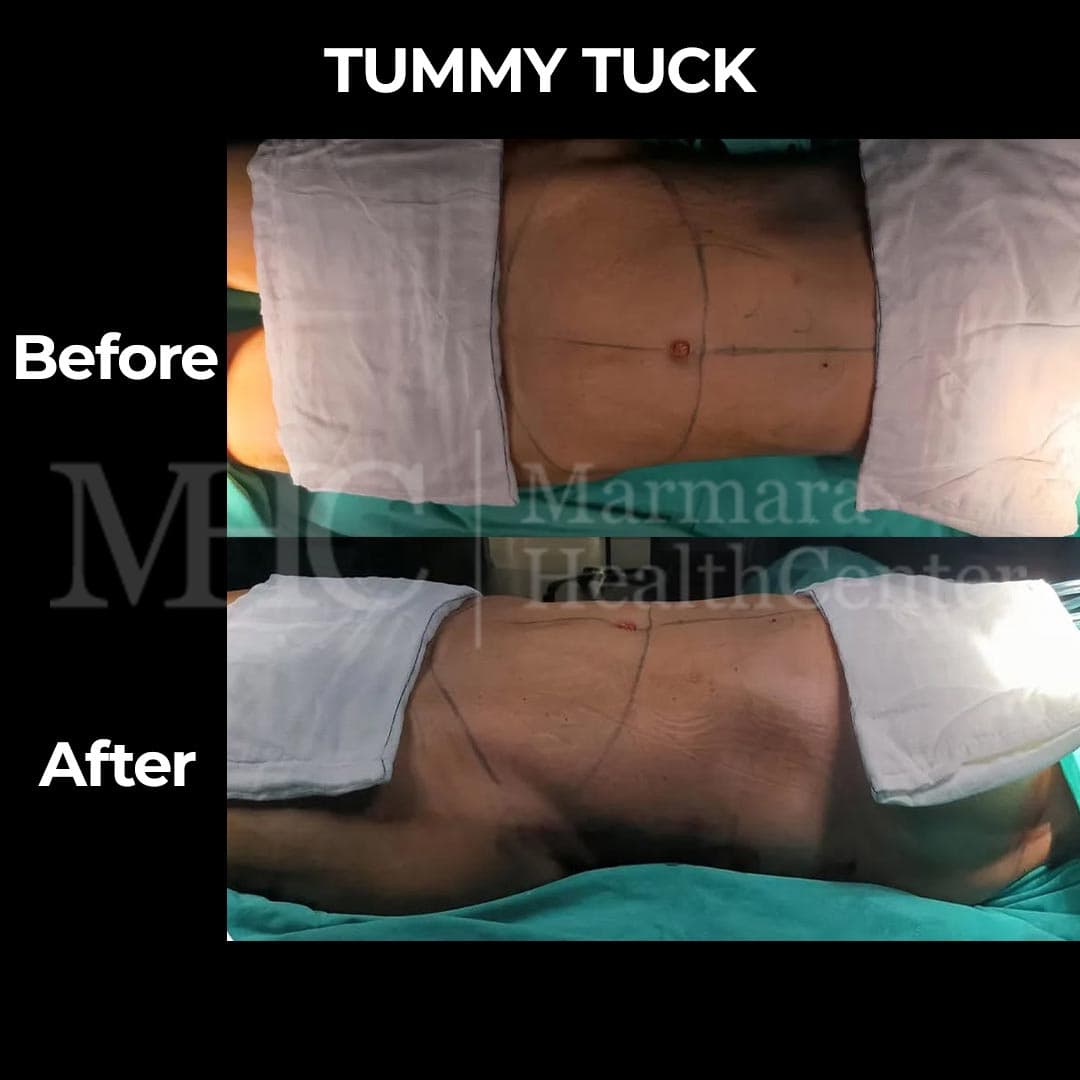 Tummy tuck (abdominoplasty) before-after result